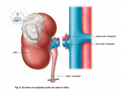 cancer-de-rinon-nefrectomia-total