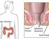 fistula-anal