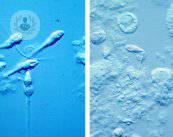 biopsia-testicular