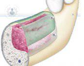 reconstruccion-osea-esquema