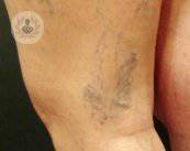 varices-esclerosis-microespuma-ecoguiada