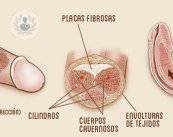 enfermedad-de-peyronie
