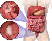 Síntomas del cáncer colorrectal, el más frecuente del aparato digestivo