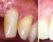 regeneracion-osea-implante-dental