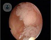 carcinoma-vesical-superficial