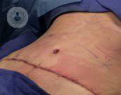 Cirugía de la pared abdominal: indicaciones y resultados