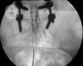 cateter-epidural