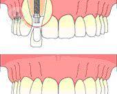 Implantes dentales: conoce sus ventajas ante los tratamientos tradicionales