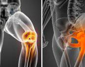 artrosis-de-rodilla-y-cadera-tratamientos