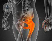 necrosis-isquemica-o-necrosis-avascular-de-cadera