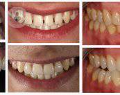 blanqueamiento-dental-carillas