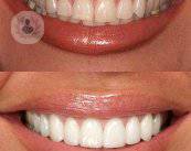 Carillas dentales para mejorar la estética de la sonrisa