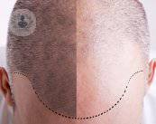 precio-injerto-capilar