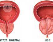 ¿Cómo se puede tratar la hiperplasia de próstata?