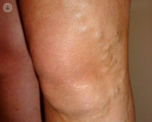 varices