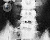 litiasis-genitourinaria