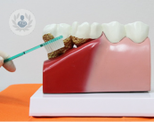 periodoncia-para-eliminar-la-enfermedad-periodontal