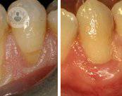 terapia-mucogingival
