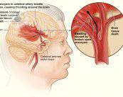 Hemorragia cerebral: qué síntomas presenta y cómo se trata
