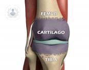 la-artrosis-afecta-a-las-articulaciones
