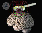 Estimulación Magnética Transcraneal para tratar enfermedades neurológicas