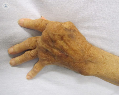 Artritis Reumatoide: qué es, causas, síntomas y tratamiento