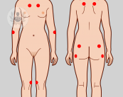 puntos-dolor-fibromialgia