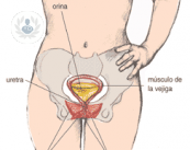 Tratamiento de la incontinencia urinaria femenina con malla ajustable