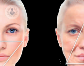 Rejuvenecimiento facial con suturas de Ácido Poliláctico y Ácido Glicólico