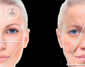 rejuvenecimiento-facial-con-acido-polilactico-y-glicolico