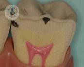 caries-inicial