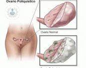 Síndrome de Ovarios Poliquísticos