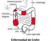 Conoce la enfermedad de Crohn y cómo abordarla