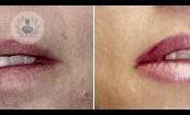 elevacion-labio-superior