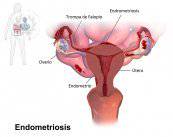 Endometriosis, una enfermedad benigna pero incapacitante