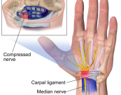 sindrome-del-tunel-carpiano