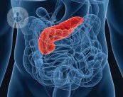 ¿Qué es el cáncer de páncreas?