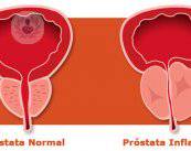 Tratamiento para la Hiperplasia Benigna de Próstata