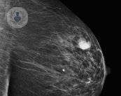 Novedosa cirugía ambulatoria en cáncer de mama