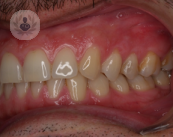 cambio-de-color-por-caries