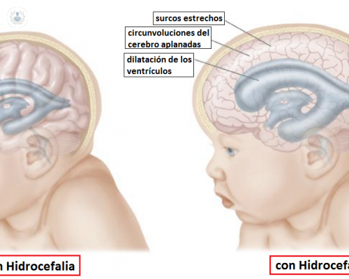 Hidrocefalia: cómo se detecta, tratamiento y cura