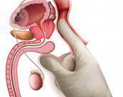 hiperplasia-benigna-de-prostata-tratamientos