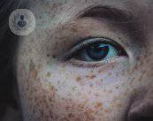 pecas-y-manchas-en-la-piel