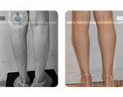 lipotransferencia-grasa-propia