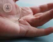 enfermedad-de-dupuytren