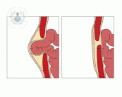 ¿Qué puede provocar la aparición de la hernia umbilical?