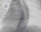 escoliosis-lumbar