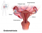 La Endometriosis afecta a un 15% de mujeres en edad fértil