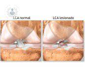 lesion-del-ligamento-cruzado-anterior