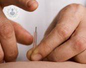 puncion-seca-para-puntos-gatillo